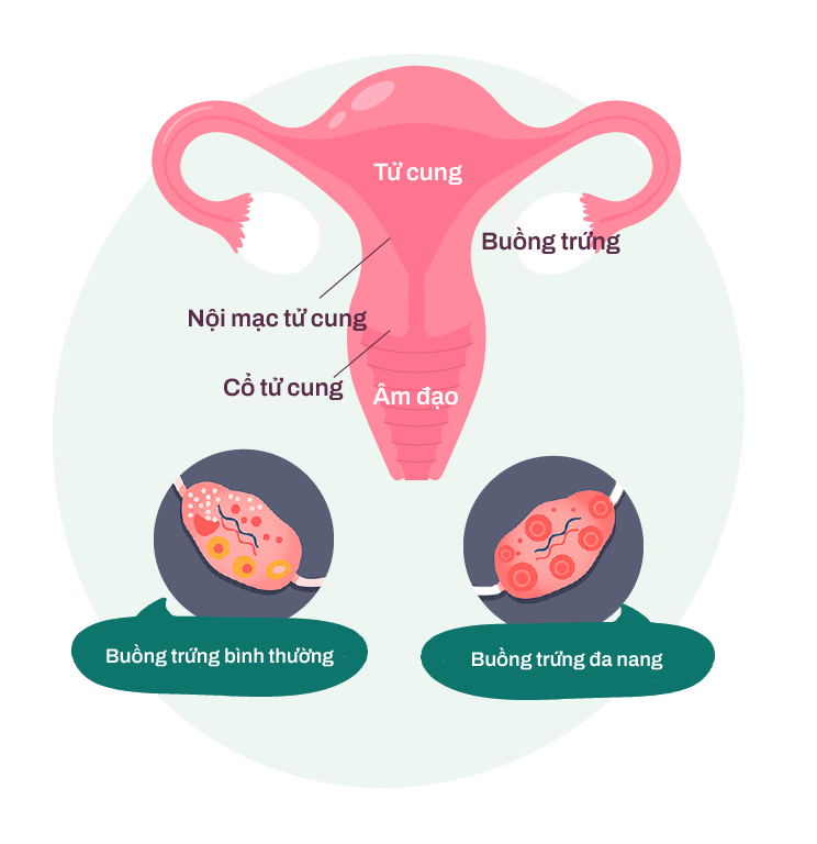 ảnh hưởng của hội chứng buồng trứng đa nang lên phụ nữ